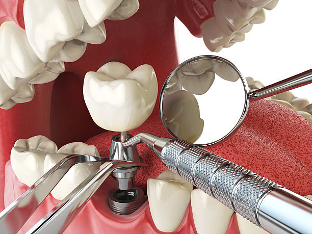 Best Emergency Wisdom Teeth Removal in Buies Creek, NC